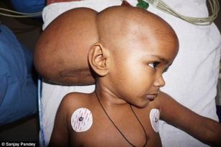 Renu, bocah perempuan berusia 4 tahun asal India menderita tumor otak raksasa di belakang kepalanya.