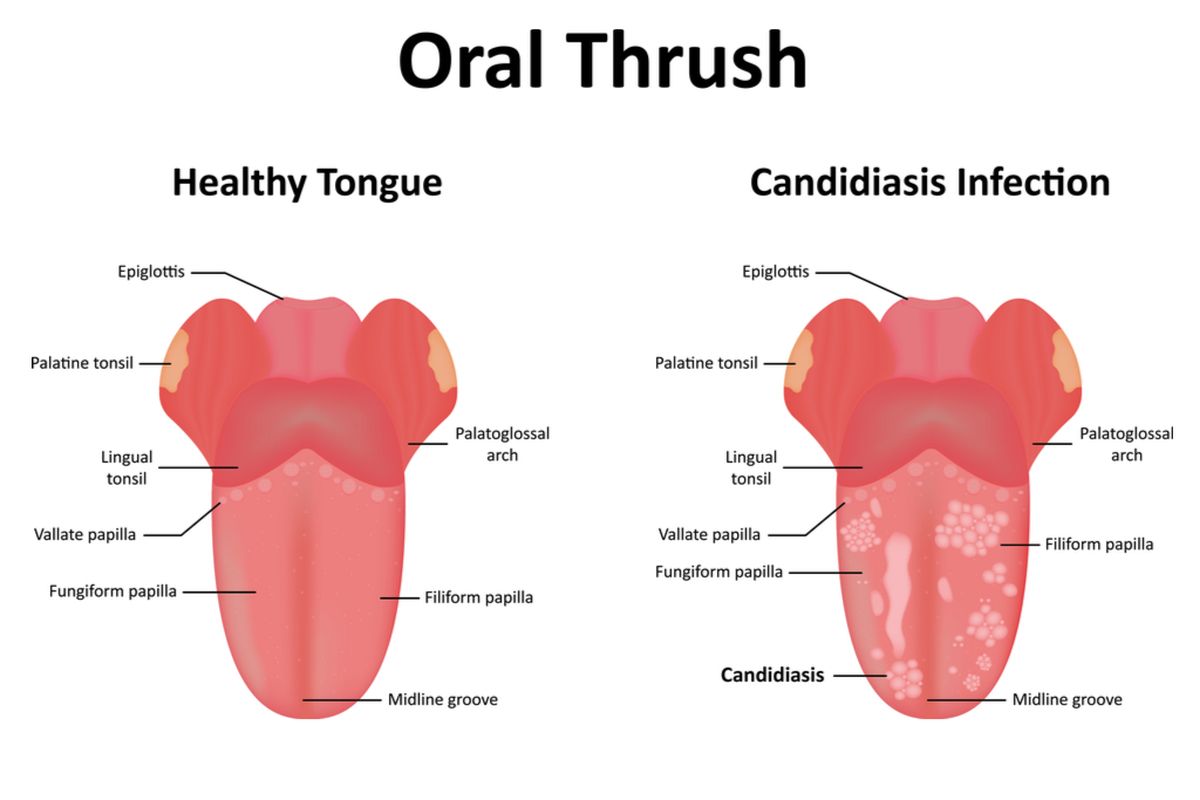 Ilustrasi oral thrush