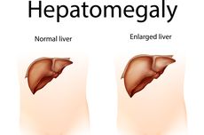 Hepatomegali