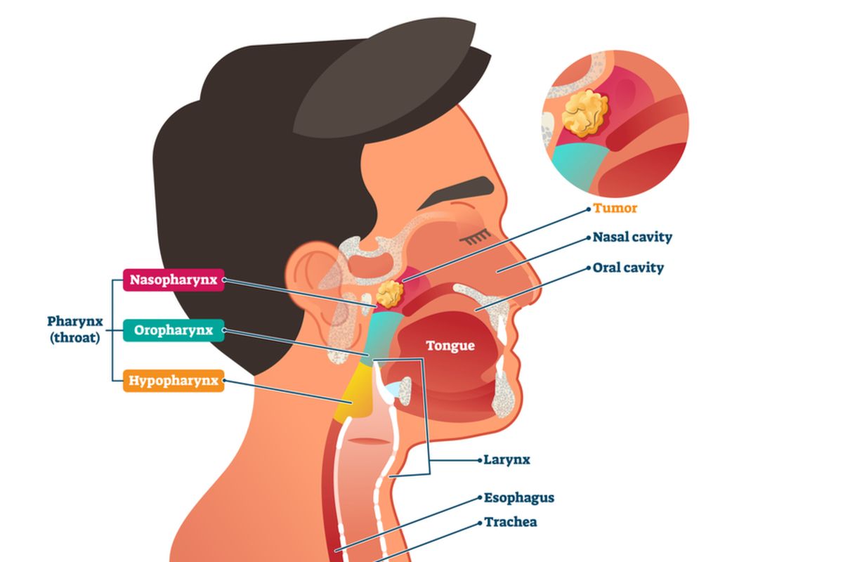 Ilustrasi kanker nasofaring atau karsinoma nasofaring.