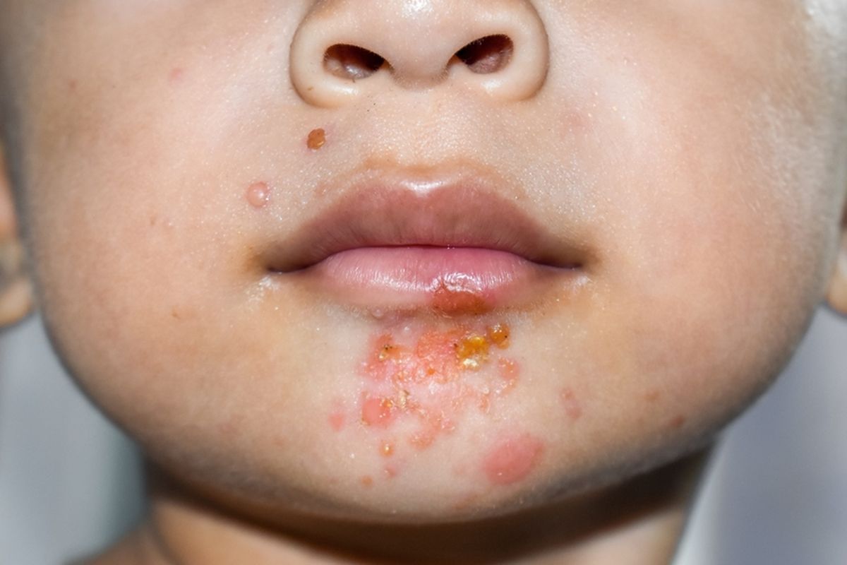 Ilustrasi Impetigo