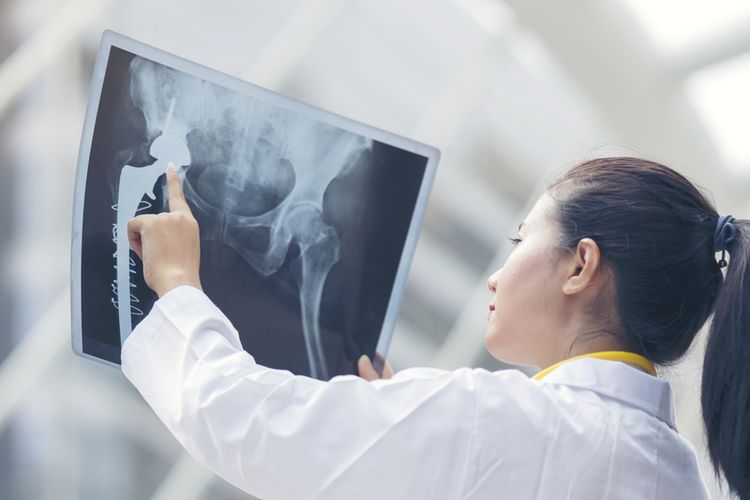 Seorang dokter sedang memeriksa hasil X-Ray pasien kanker tulang. Cara mengobati kanker tulang yang paling umum meliputi operasi, kemoterapi, dan radioterapi. 