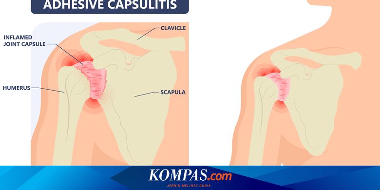 Penyakit Frozen Shoulder - Gejala Penyebab Pengobatan - Kompascom