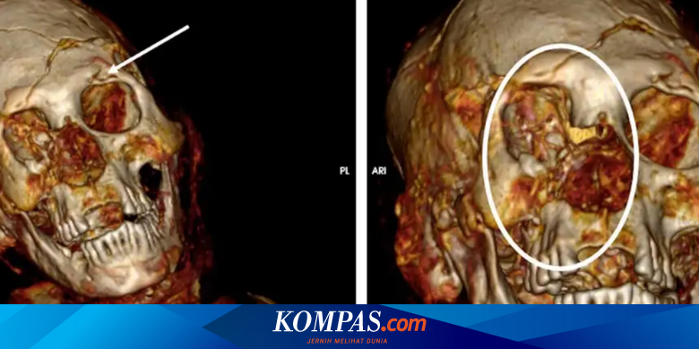 Misteri Kematian Mumi Berusia 1000 Tahun Terungkap Lewat CT Scan - Vimarsana News