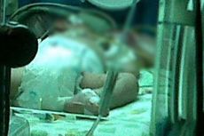 Bayi Kembar Parasit Lepas, Mulut Ginan Tak Bisa Menutup