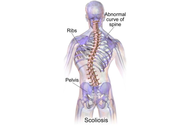 Ilustrasi tulang belakang yang mengalami skoliosis. Skoliosis merupakan kondisi tulang belakang bengkok abnormal ke samping kanan atau ke kiri (lateral).
