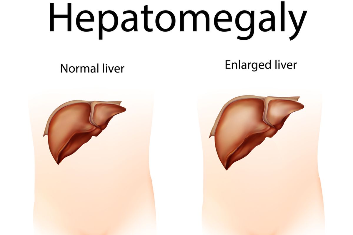 Ilustrasi Hepatomegali