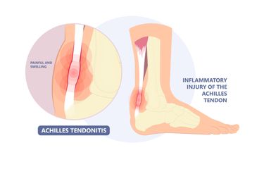 Penyakit Cedera Tendon Achilles - Gejala, Penyebab, Pengobatan ...