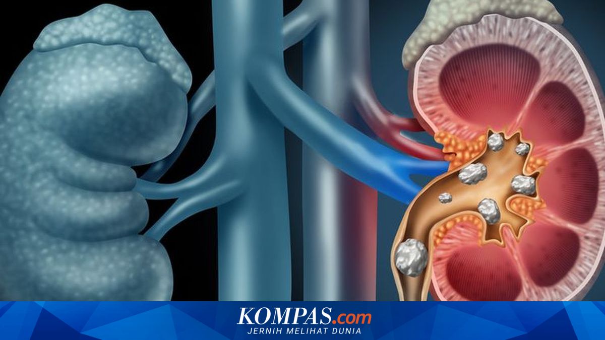 Bukan Cuma Kurang Minum, Makanan Ini Juga Bisa Picu Batu Ginjal