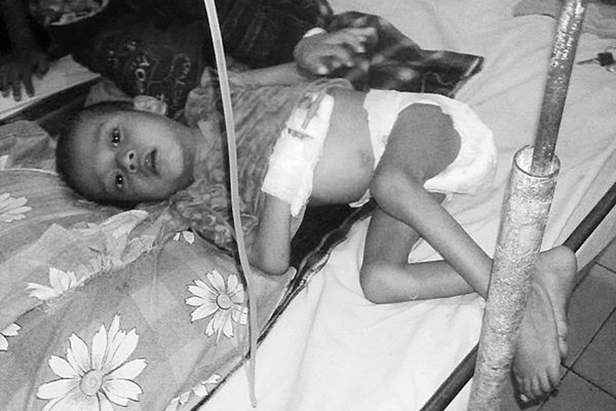 Hery(3) adalah anak balita penderita gizi buruk di Palu, Sulawesi Tengah. Berat badannya hanya 7,8 kg dari seharusnya minimal 12 kg. Hery merupakan satu dari 553 anak gizi buruk di Sulteng.