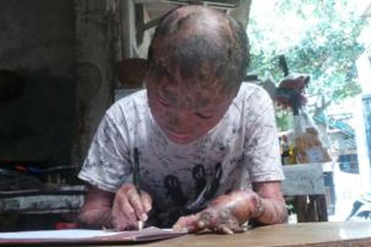 Ari Wibowo (17), remaja yang memiliki kulit seperti sisik ular hobi menggambar.