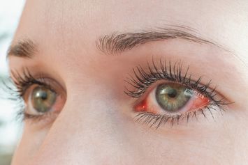 18 Penyebab Mata Berlendir dan Buram, Ada Alergi dan Katarak