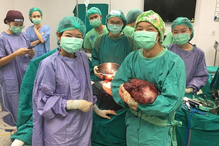 Tim bedah Rumah Sakit Bueng Kan, Thailand, menggendong tumor seberat 5 kilogram yang diangkat dari perut seorang pria 52 tahun.