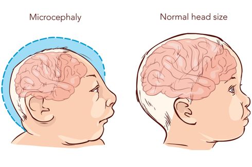 Mengenal Mikrosefalus, Kelainan yang Sebabkan Kepala Bayi Berukuran Kecil