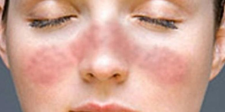 Penyakit Lupus: Penyebab, Gejala, dan Komplikasi - Vimarsana News