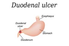 Ulkus Duodenum