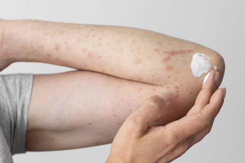 4 Bahan Skincare yang Bisa Meredakan Gejala Eksim