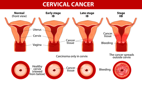 Ciri-ciri Kanker Serviks Stadium Awal dan Lanjut