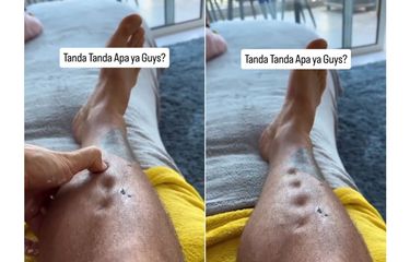 Cekungan di Kaki Tak Kembali Normal Usai Ditekan, Tanda Penyakit ...