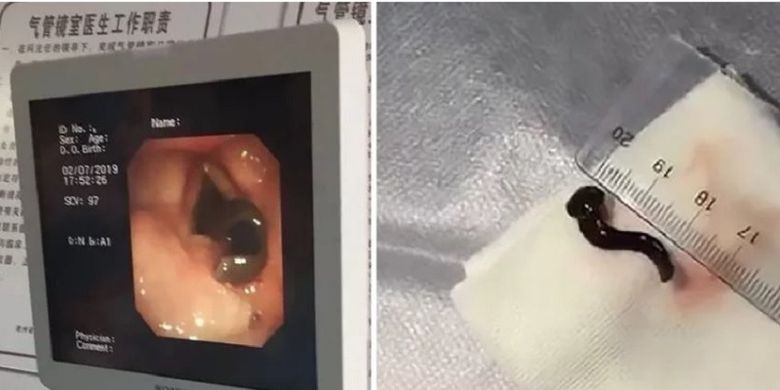 Potongan gambar video memperlihatkan bagaimana ada lintah yang hidup dalam tenggorokan seorang pria di China. Pria itu memeriksakan diri di rumah sakit setelah mengalami batuk selama dua bulan.