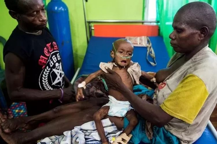 Foto yang diabadikan tahun 2018 ini memperlihatkan seorang anak kekurangan gizi menjalani perawatan di RSUD Agats, satu-satunya rumah sakit di Kabupaten Asmat.