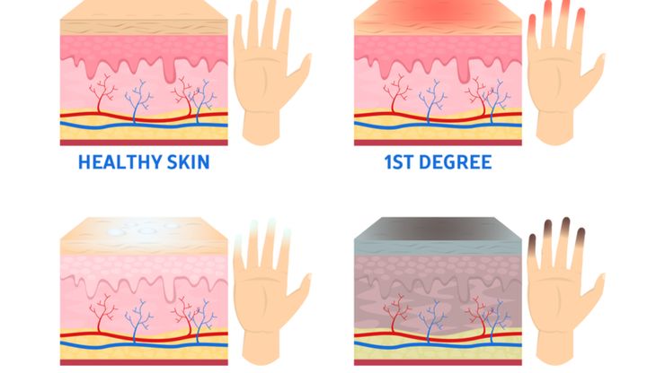 Frostbite: Tubuh ketika Dimakan Oleh Suhu Dingin