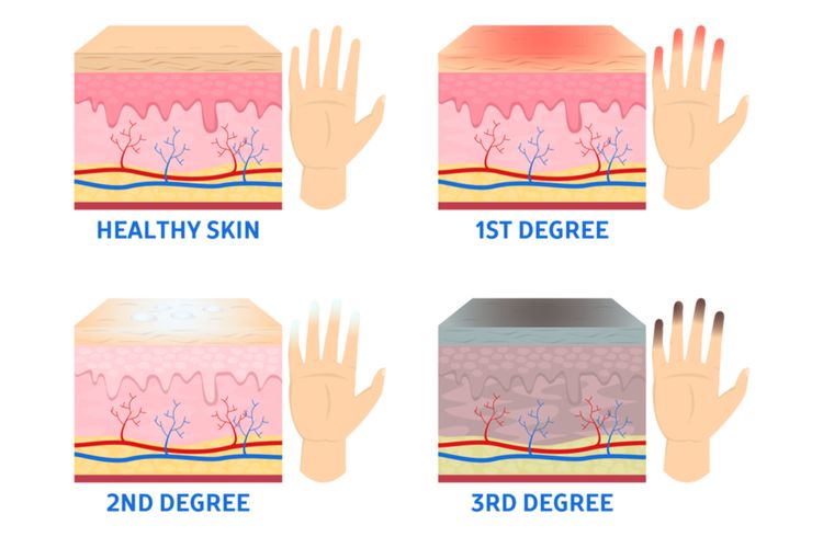 Ilustrasi tahap frostbite (radang dingin). Frostbite terjadi ketika lapisan kulit serta jaringan yang di bawahnya mati. Ini mengubah kulit bagian tubuh Anda hitam dan keras.