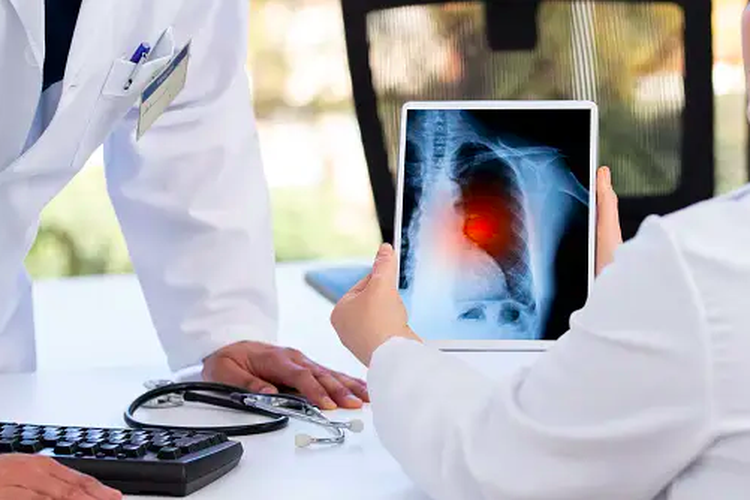 Ilustrasi pengobatan kanker paru