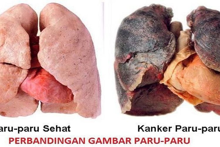 Metode Minimal Invasif : Harapan Pasien Kanker Paru Stadium Lanjut