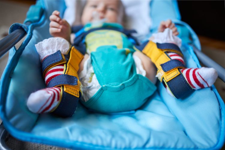 Ilustrasi bayi menggunakan harness untuk mengkoreksi displasia pinggul