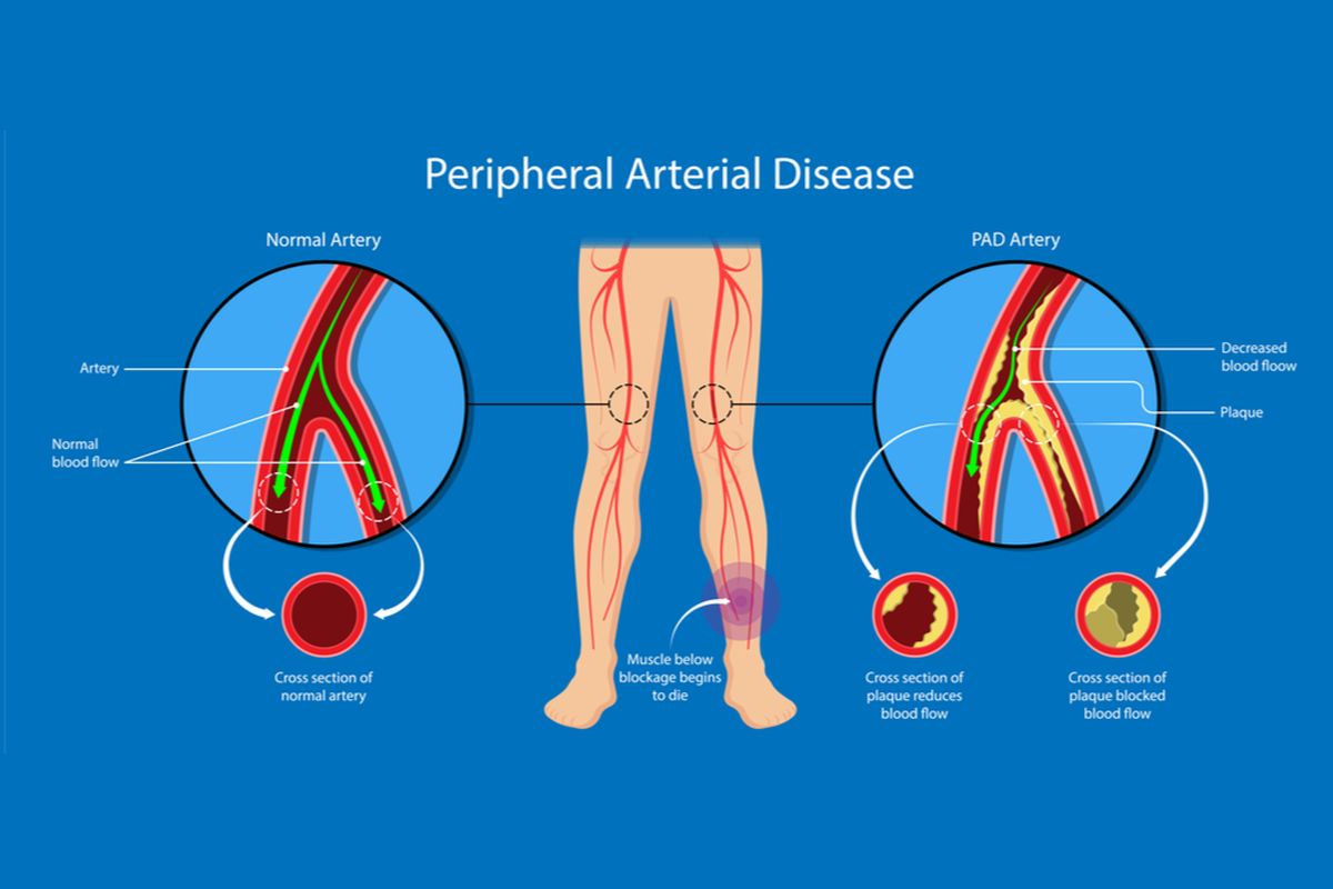 Ilustrasi penyakit arteri perifer