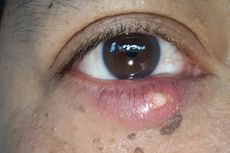 8 Penyebab Blefaritis (Radang Kelopak Mata) yang Perlu Diwaspadai