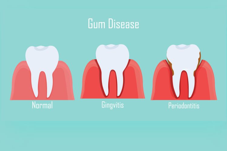 Ilustrasi radang gusi
