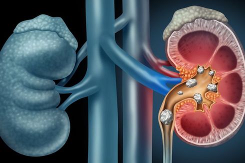 4 Komplikasi Batu Ginjal yang Harus Diwasadai