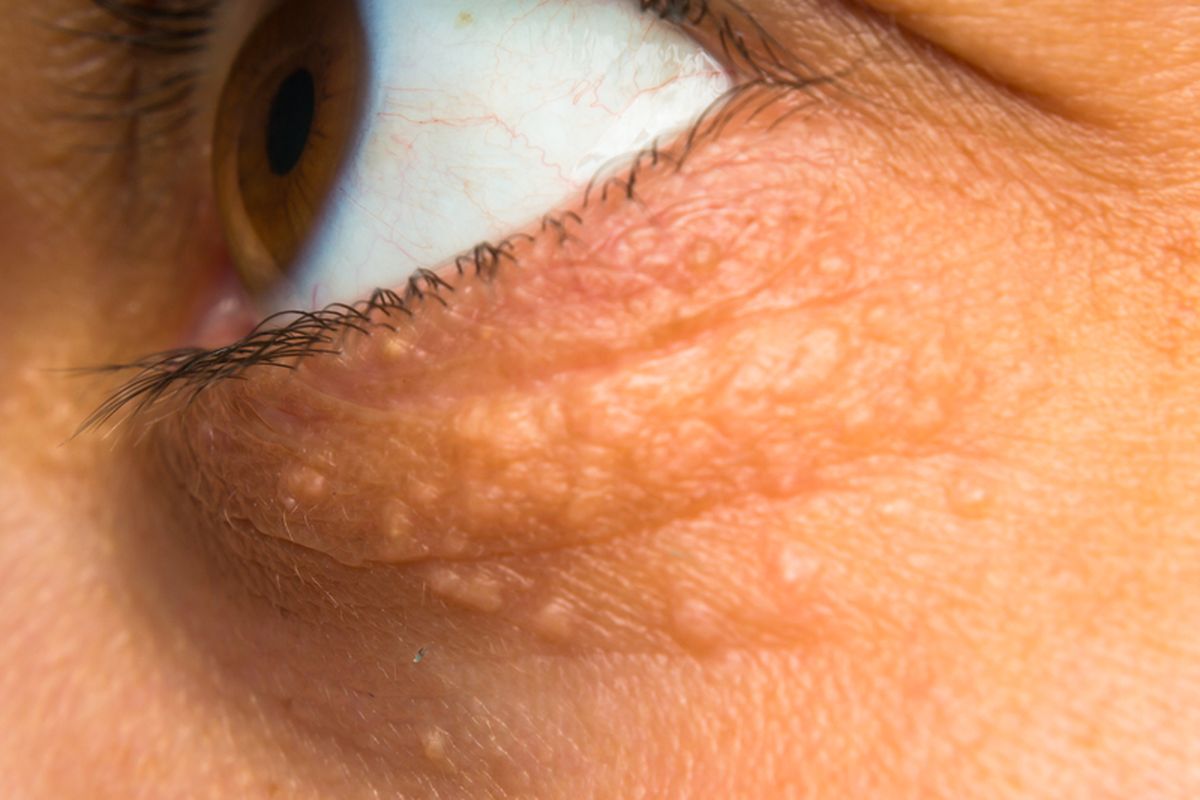 Xanthelasma