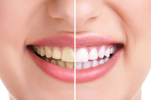 3 Cara Menghilangkan Plak Gigi Secara Alami