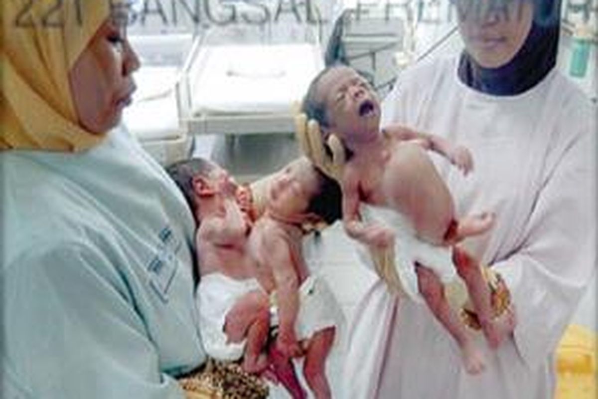 Kembar siam parasit, Jovansa (kanan) dan kembar siam Janeeta-Janeetra