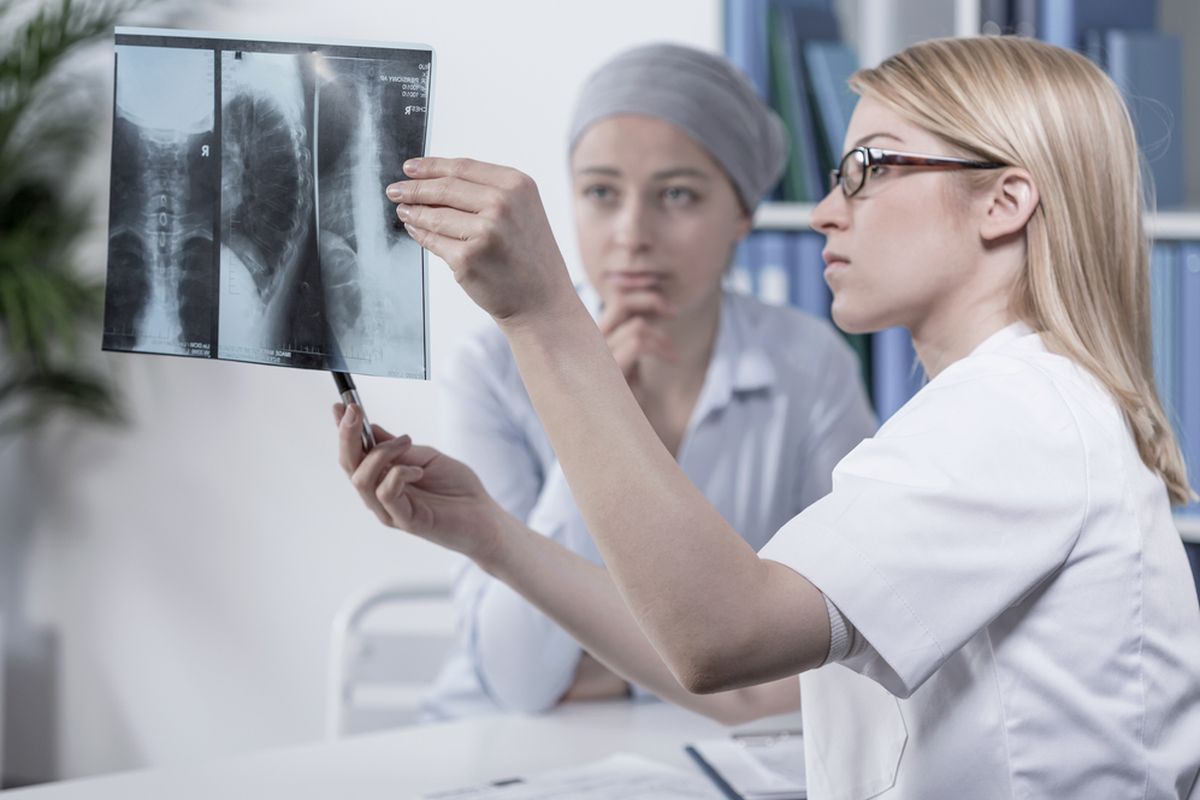Ilustrasi kanker paru-paru pada wanita, gejala kanker paru-paru pada wanita, ciri-ciri kanker paru pada wanita