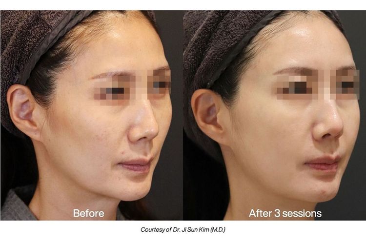 Hasil treatment mesin LINEAR Z produksi Jeisys.