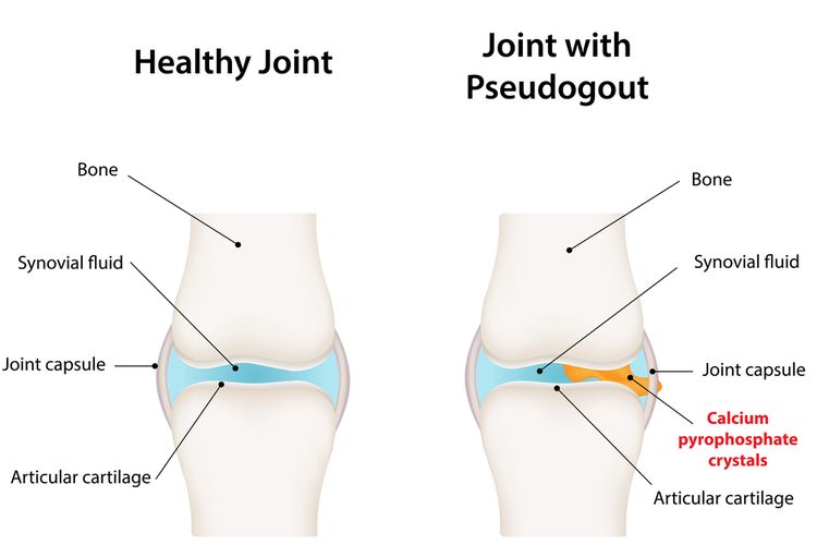 Ilustrasi Pseudogout