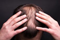 Mengapa Laki-laki Lebih Mungkin Botak daripada Perempuan?