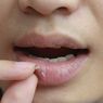 7 Cara Mengatasi Bibir Pecah-pecah