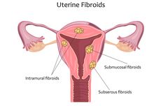 Kenali Apa Itu Fibroid Rahim, Penyebab, dan Gejalanya