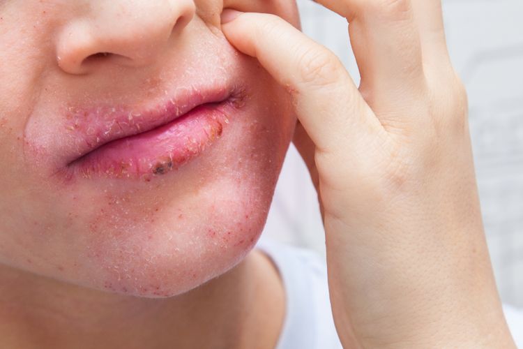 Mengetahui penyebab bibir kering dan gatal sangatlah penting agar bisa menemukan perawatan dan pengobatan yang tepat.