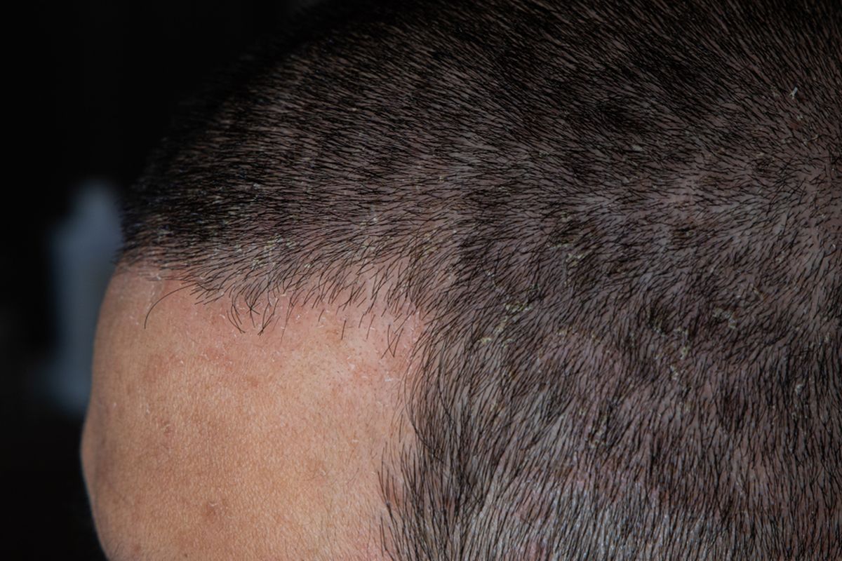 Ilustrasi dermatitis seboroik, ketombe berkerak, kerak di kulit kepala