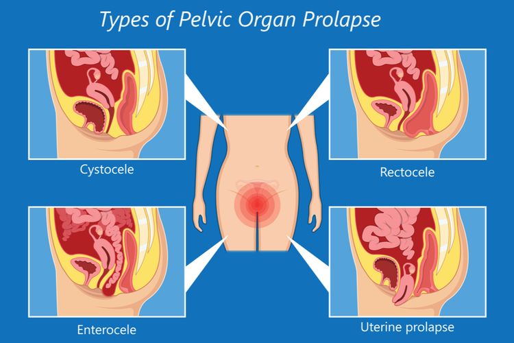 Ilustrasi Pelvic Organ Prolapse