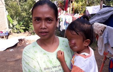 Mari Bantu Dela Puspita, Balita Penderita Tumor Ganas di Mata