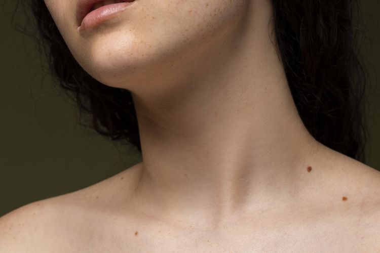 Ilustrasi keratosis di leher. Menyemprotkan parfum ke leher diklaim dapat menyebabkan keratosis seboroik dengan ciri bintil hitam menyerupai tahi lalat.