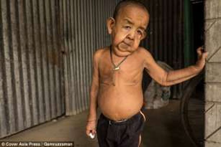 Bayezid Hossain berusia 4 tahun, tetapi terlihat seperti berusia 80 tahun karena penyakit langka progeria.