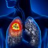 5 Penyebab Kanker Paru-paru, Tak Hanya Rokok